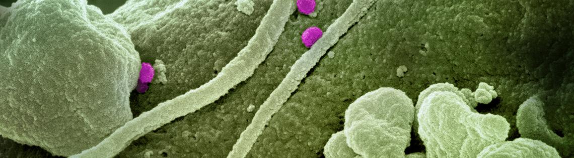 Colorized scanning electron micrograph of Crimean-Congo hemorrhagic fever (CCHF) virus particles