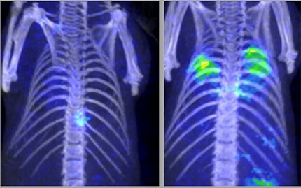 Scans of human lungs: one shows healthy lungs; the other shows bright green spots signaling fungal pneumonia