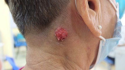 A large tumor on the side of neck