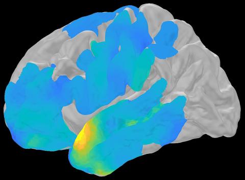 Image of a human brain in gray, with large swathes colored blue and turquoise, and one small yellow patch.